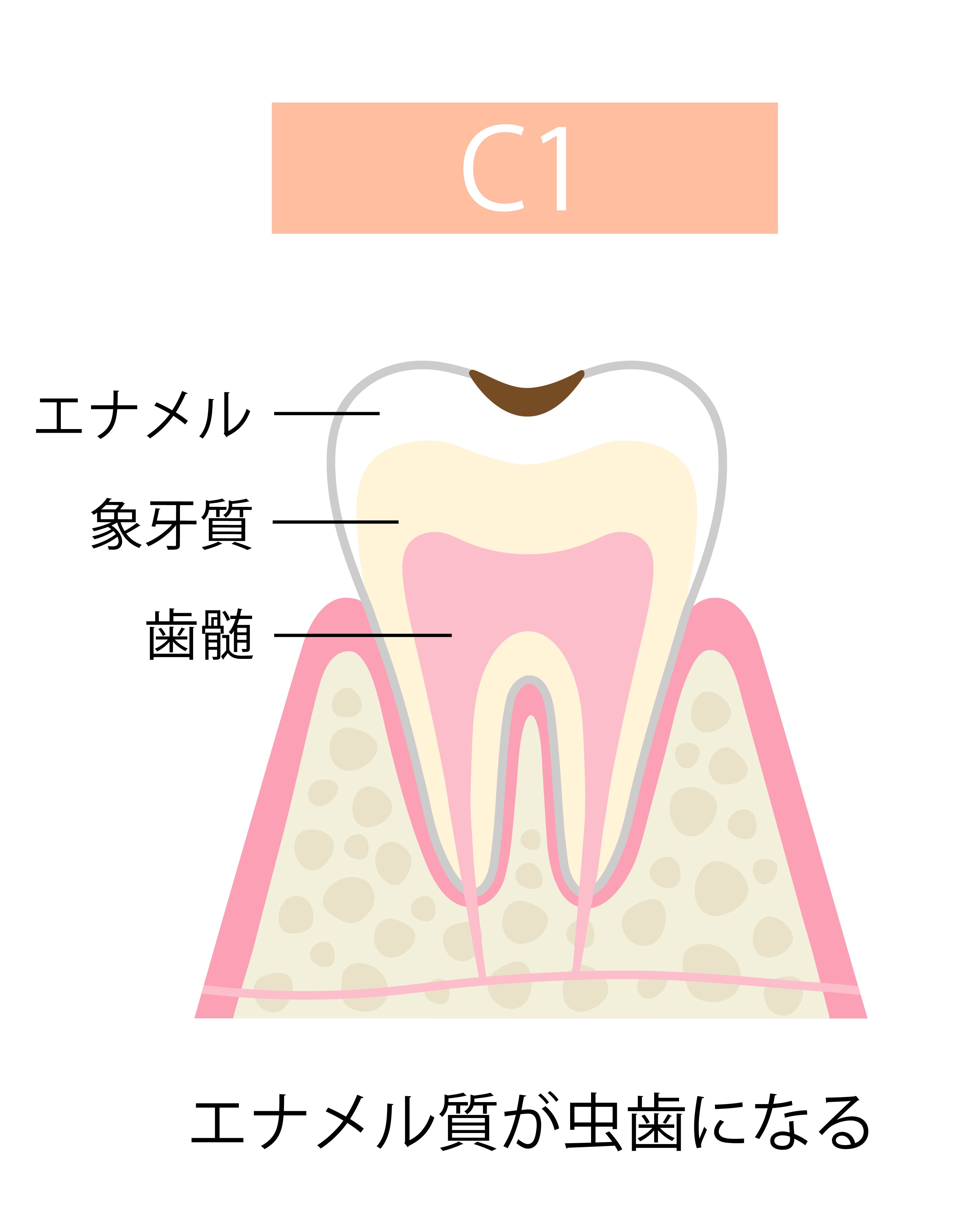 虫歯の進行と全身への影響