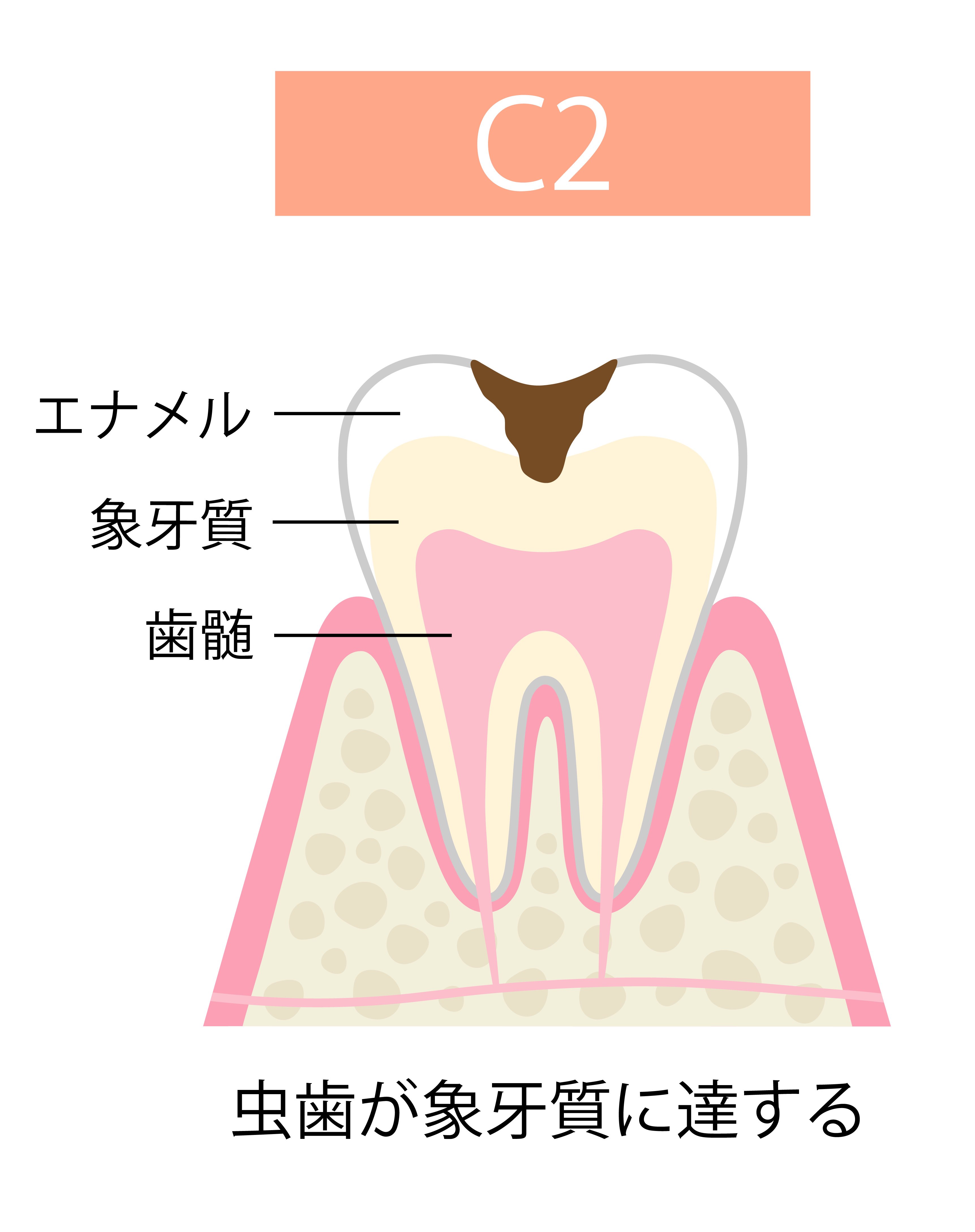 虫歯の進行と全身への影響