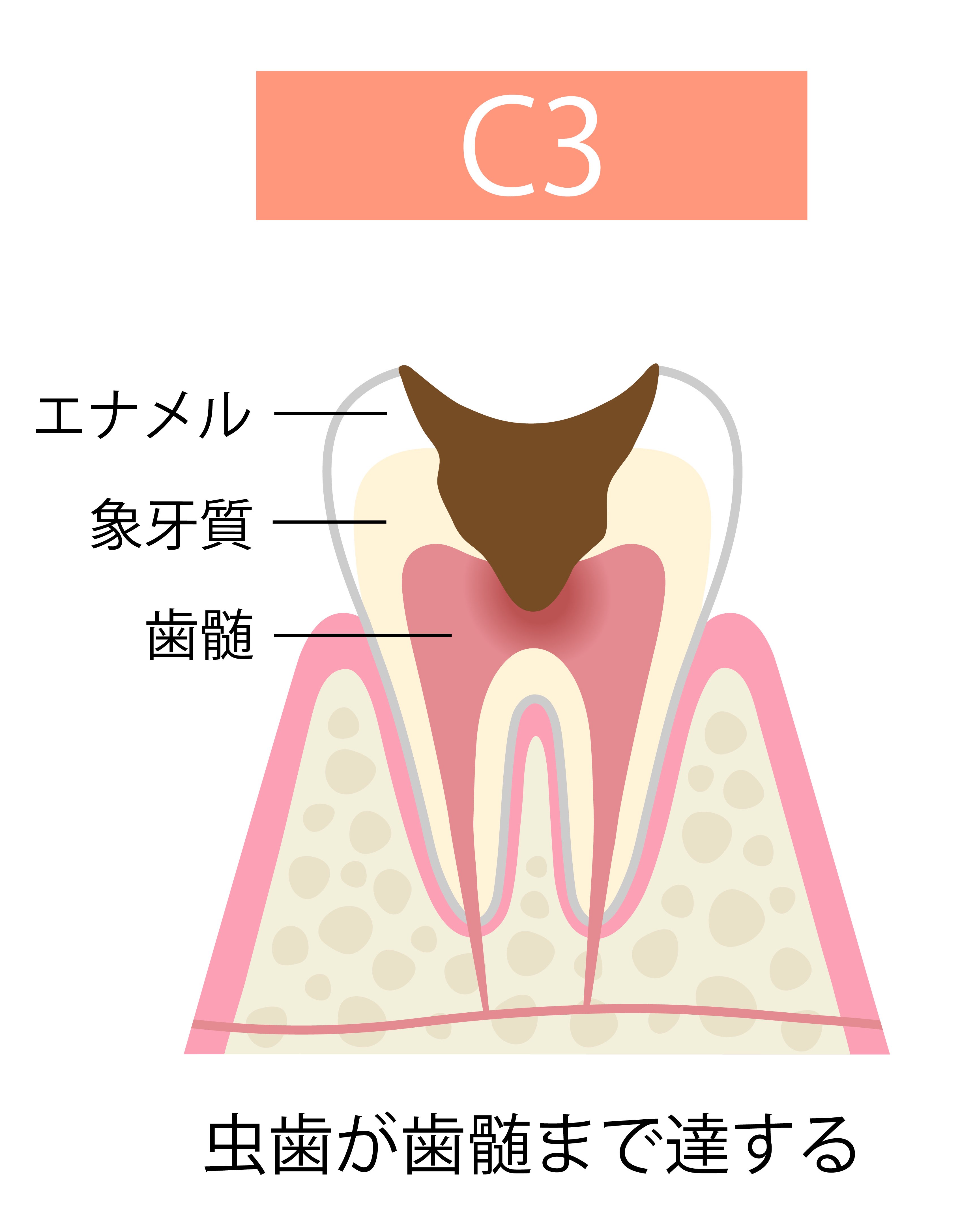 虫歯の進行と全身への影響
