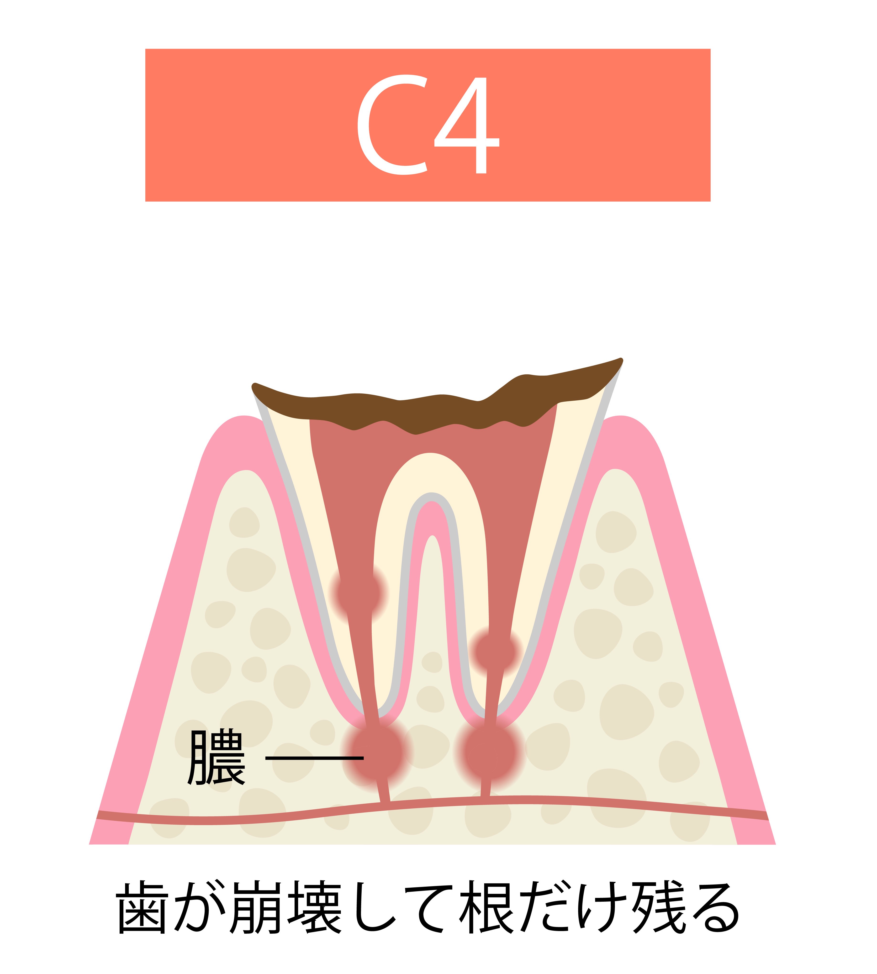 虫歯の進行と全身への影響