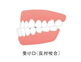 受け口（反対咬合）