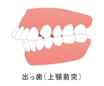 出っ歯（上顎前突）