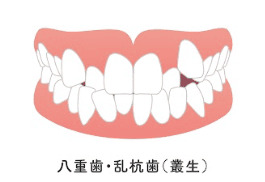 歯並びの乱れ（叢生）