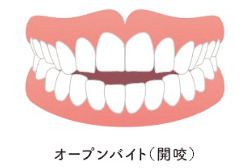 前歯が噛み合わない（開咬）